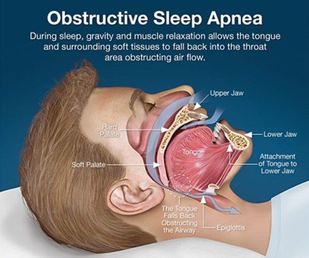 What Is Obstructive Sleep Apnea?: Central Avenue Dental